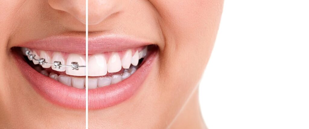 invisalign dentista monza e seregno 2