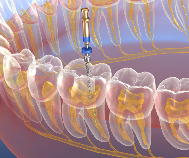 devitalizzaizone dente molare