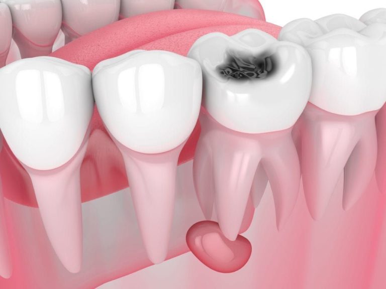 dente da otturare