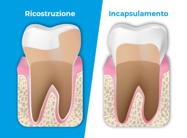 devitalizzazione-ricostruzione-o-capsula